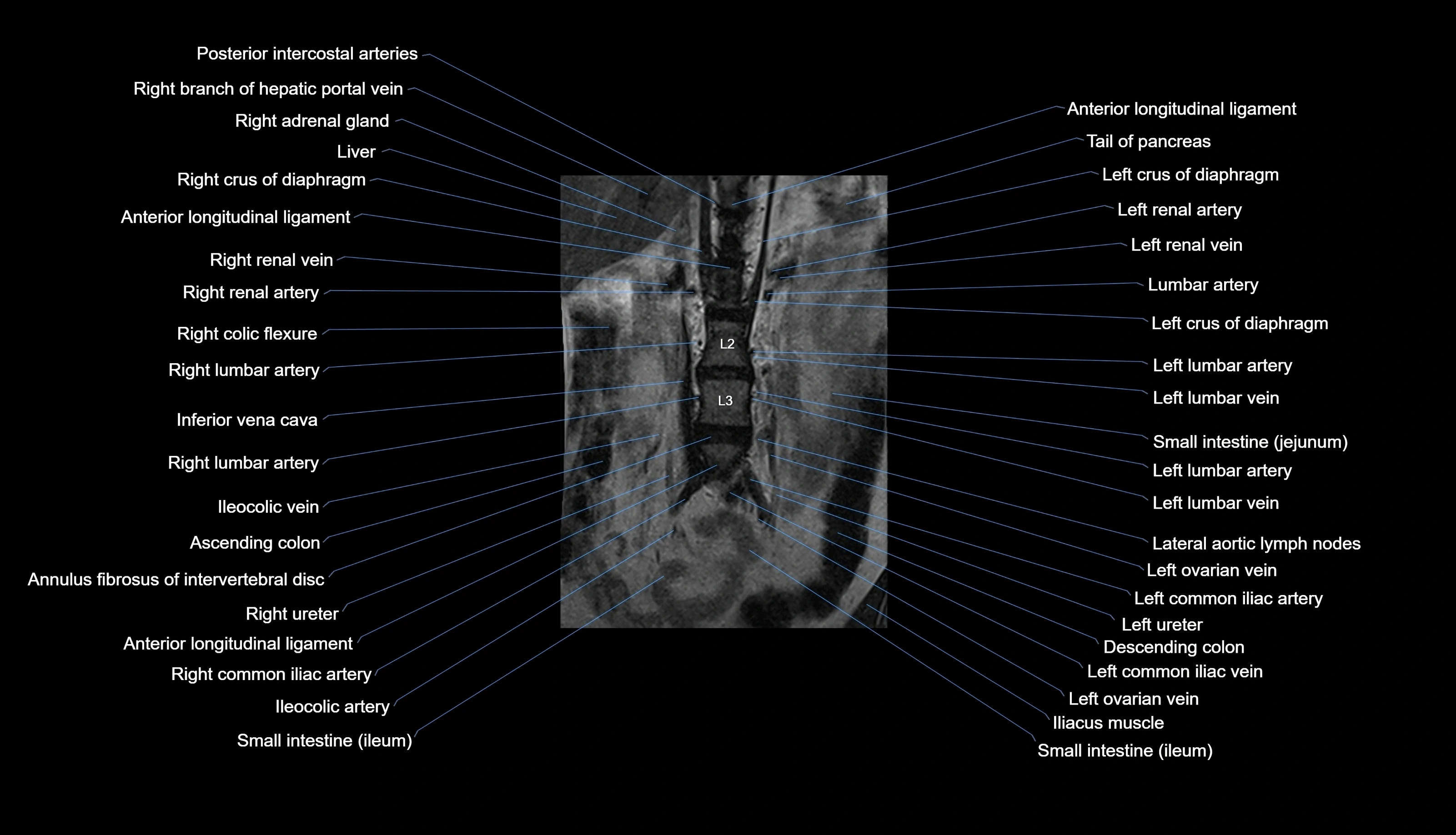 MRI lumbar spine labelled coronal cross sectional anatomy 3T radiology-img-00001-00005.webp